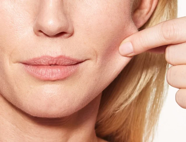 Sculptra Before