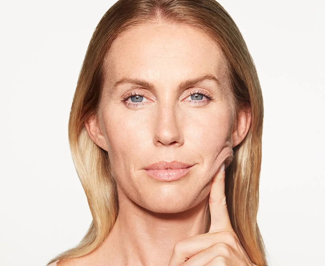 Sculptra-Vorher