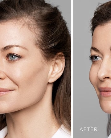 Fühlen sich die Lippen mit HA-Lip Filler natürlich an oder nicht