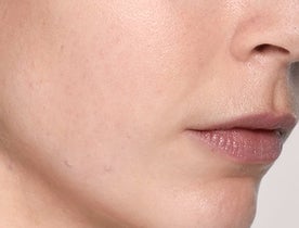 Consumer_V3_Skinboosters_Face_BAsmall_Carmela_After