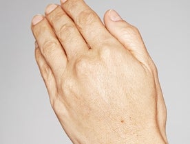 Consumer_V3_Skinboosters_Hands_BAsmall_Jenny_After