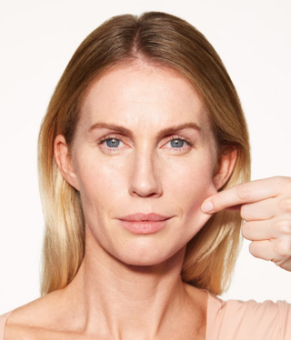 Sculptra® Regenerative biostimulator-after