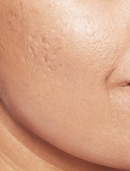 Lassen Sie nicht zu, dass Aknenarben Ihr Selbstbewusstsein beeinträchtigen