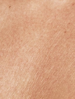 Trockene Haut kann viele Ursachen haben. Welche Behandlungen sind für Sie am besten geeignet?