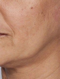 Was ist schlaffe Haut?