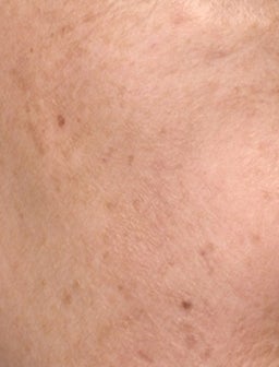 Was ist Hautpigmentierung?