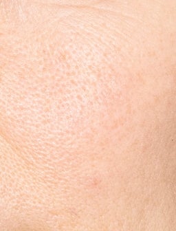 Was bedeutet Hauttextur?