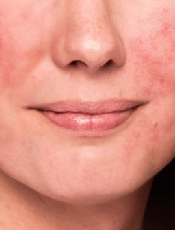 Calm-skin’s redness